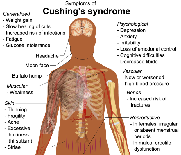 Posterdiagramm des menschlichen Körpers mit der Beschriftung "Symptome des Cushing-Syndroms", das die von Müdigkeit, Kopfschmerzen und anderen Symptomen betroffenen Bereiche hervorhebt.